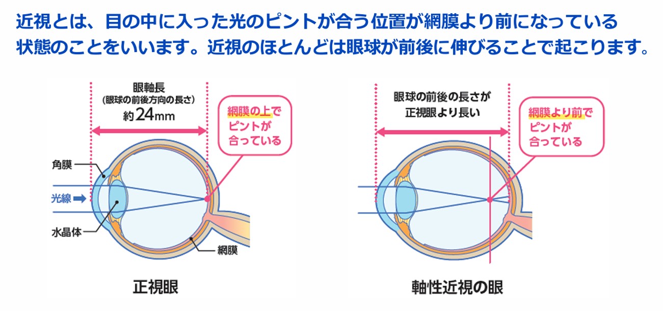 近視とは、目の中に入った光のピントが合う位置が網膜より前になっている状態のことをいいます。近視のほとんどは眼球が前後に伸びることで起こります。